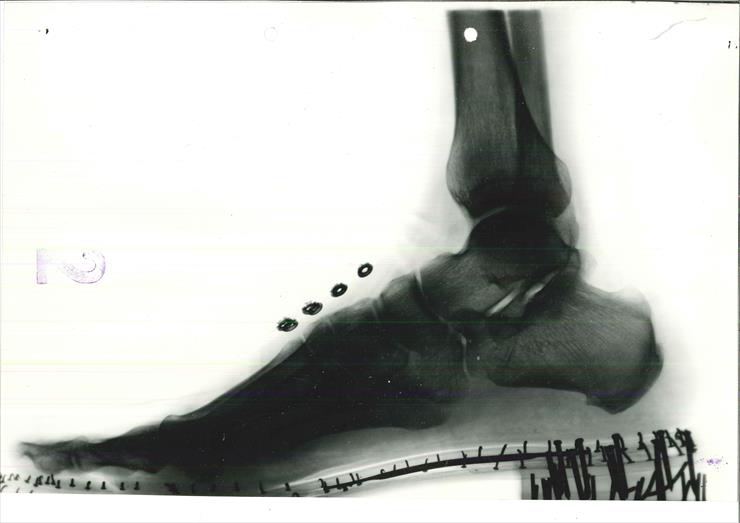 STOPY - zdjęcia rentgenowskie w obuwiu - 20120530065100823_0001.jpg