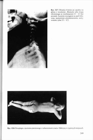 Schorzenia i urazy kręgosłupa, Kiwerski 1997 - 0000246.jpg